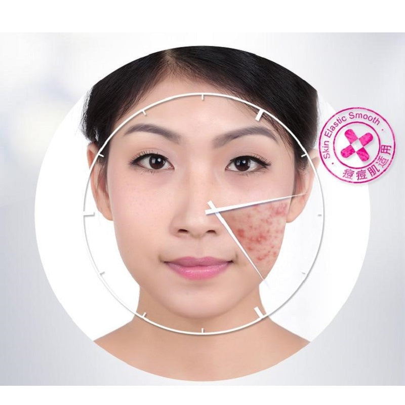 Effective Anti Acne Scar Pimple Removal Cream - BIOAQUA® OFFICIAL STORE